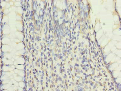 Immunohistochemistry of paraffin-embedded human colon cancer using CSB-PA019883LA01HU at dilution of 1:100