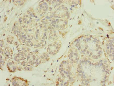 Immunohistochemistry of paraffin-embedded human breast cancer using CSB-PA019883LA01HU at dilution of 1:100
