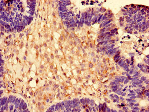 Immunohistochemistry of paraffin-embedded human ovarian cancer using CSB-PA020217EA01HU at dilution of 1:100 Immunohistochemistry of paraffin-embedded human ovarian cancer using CSB-PA020217EA01HU at dilution of 1:100