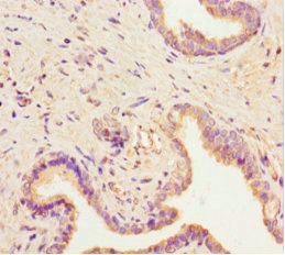 Immunohistochemistry of paraffin-embedded human prostate cancer using CSB-PA020751LA01HU at dilution of 1:100
