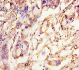 Immunohistochemistry of paraffin-embedded human pancreatic cancer using CSB-PA020751LA01HU at dilution of 1:100