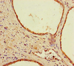 Immunohistochemistry of paraffin-embedded human prostate cancer using CSB-PA021263LA01HU at dilution of 1:100 Immunohistochemistry of paraffin-embedded human prostate cancer using CSB-PA021263LA01HU at dilution of 1:100