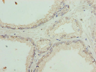 Immunohistochemistry of paraffin-embedded human prostate cancer using CSB-PA021577LA01HU at dilution of 1:100 Immunohistochemistry of paraffin-embedded human prostate cancer using CSB-PA021577LA01HU at dilution of 1:100