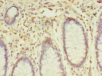 Immunohistochemistry of paraffin-embedded human colon cancer using CSB-PA022369HA01HU at dilution of 1:100 Immunohistochemistry of paraffin-embedded human colon cancer using CSB-PA022369HA01HU at dilution of 1:100