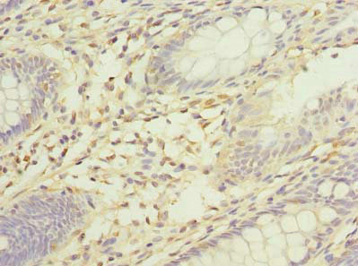 Immunohistochemistry of paraffin-embedded human colon cancer using CSB-PA022406LA01HU at dilution of 1:100