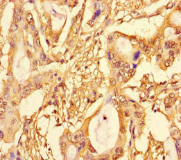 Immunohistochemistry of paraffin-embedded human pancreatic cancer using CSB-PA022956LA01HU at dilution of 1:100