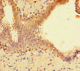 Immunohistochemistry of paraffin-embedded human prostate cancer using CSB-PA022956LA01HU at dilution of 1:100