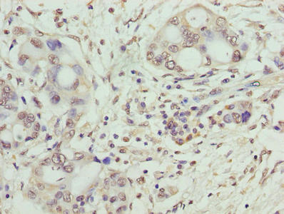 Immunohistochemistry of paraffin-embedded human pancreatic cancer using CSB-PA023018LA01HU at dilution of 1:100