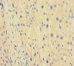Immunohistochemistry of paraffin-embedded human liver cancer using CSB-PA023240LA01HU at dilution of 1:100 Immunohistochemistry of paraffin-embedded human liver cancer using CSB-PA023240LA01HU at dilution of 1:100