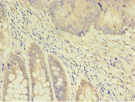 Immunohistochemistry of paraffin-embedded human colon cancer using CSB-PA023577HA01HU at dilution of 1:100