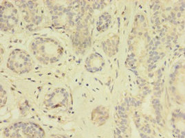Immunohistochemistry of paraffin-embedded human breast cancer using CSB-PA023577HA01HU at dilution of 1:100