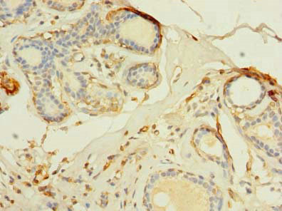 Immunohistochemistry of paraffin-embedded human breast cancer using CSB-PA023758LA01HU at dilution of 1:100 Immunohistochemistry of paraffin-embedded human breast cancer using CSB-PA023758LA01HU at dilution of 1:100
