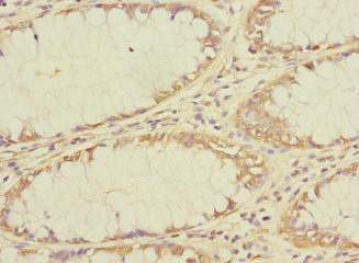 Immunohistochemistry of paraffin-embedded human colon cancer using CSB-PA023803LA01HU at dilution of 1:100 Immunohistochemistry of paraffin-embedded human colon cancer using CSB-PA023803LA01HU at dilution of 1:100