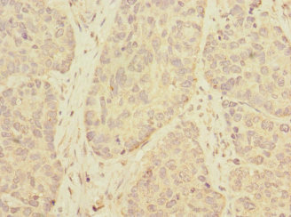Immunohistochemistry of paraffin-embedded human ovarian cancer using CSB-PA023803LA01HU at dilution of 1:100