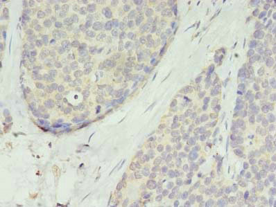 Immunohistochemistry of paraffin-embedded human gastric cancer using CSB-PA023842LA01HU at dilution of 1:100 Immunohistochemistry of paraffin-embedded human gastric cancer using CSB-PA023842LA01HU at dilution of 1:100