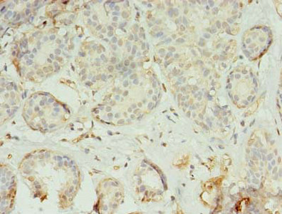 Immunohistochemistry of paraffin-embedded human breast cancer using CSB-PA023842LA01HU at dilution of 1:100