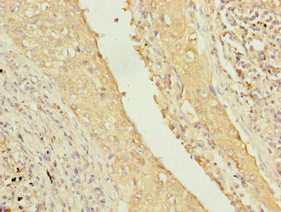 Immunohistochemistry of paraffin-embedded human lung cancer using CSB-PA023855LA01HU at dilution of 1:100