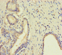 Immunohistochemistry of paraffin-embedded human prostate cancer using CSB-PA023918LA01HU at dilution of 1:100
