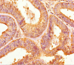 Immunohistochemistry of paraffin-embedded human endometrial cancer using CSB-PA024133LA01HU at dilution of 1:100 Immunohistochemistry of paraffin-embedded human endometrial cancer using CSB-PA024133LA01HU at dilution of 1:100