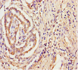 Immunohistochemistry of paraffin-embedded human pancreatic cancer using CSB-PA024133LA01HU at dilution of 1:100