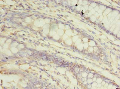 Immunohistochemistry of paraffin-embedded human colon cancer using CSB-PA024229LA01HU at dilution of 1:100