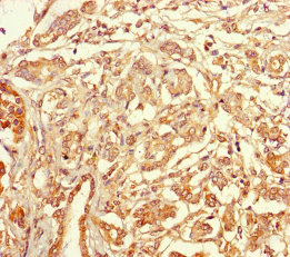 Immunohistochemistry of paraffin-embedded human pancreatic cancer using CSB-PA025165LA01HU at dilution of 1:100