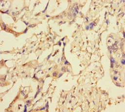 Immunohistochemistry of paraffin-embedded human pancreatic cancer using CSB-PA026193LA01HU at dilution of 1:100 Immunohistochemistry of paraffin-embedded human pancreatic cancer using CSB-PA026193LA01HU at dilution of 1:100
