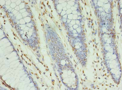 Immunohistochemistry of paraffin-embedded human colon cancer using CSB-PA026233LA01HU at dilution of 1:100