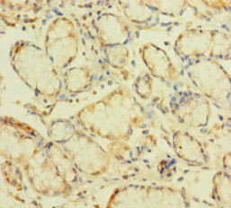 Immunohistochemistry of paraffin-embedded human gastric cancer using CSB-PA026619LA01HU at dilution of 1:100 Immunohistochemistry of paraffin-embedded human gastric cancer using CSB-PA026619LA01HU at dilution of 1:100