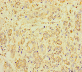 Immunohistochemistry of paraffin-embedded human pancreatic cancer using CSB-PA026644LA01HU at dilution of 1:100 Immunohistochemistry of paraffin-embedded human pancreatic cancer using CSB-PA026644LA01HU at dilution of 1:100