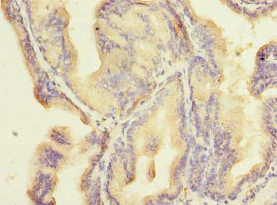 Immunohistochemistry of paraffin-embedded human prostate cancer using CSB-PA026893LA01HU at dilution of 1:100