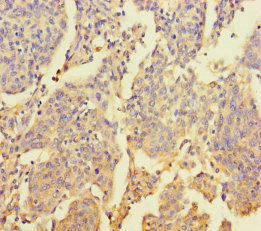 Immunohistochemistry of paraffin-embedded human cervical cancer using CSB-PA026928LA01HU at dilution of 1:100