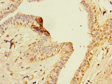 Immunohistochemistry of paraffin-embedded human breast cancer using CSB-PA026936LA01HU at dilution of 1:100