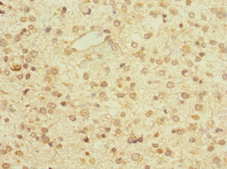 Immunohistochemistry of paraffin-embedded human glioma using CSB-PA027030LA01HU at dilution of 1:100 Immunohistochemistry of paraffin-embedded human glioma using CSB-PA027030LA01HU at dilution of 1:100