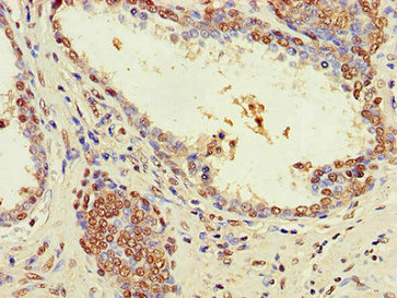 Immunohistochemistry of paraffin-embedded human prostate cancer using CSB-PA027086LA01HU at dilution of 1:100 Immunohistochemistry of paraffin-embedded human prostate cancer using CSB-PA027086LA01HU at dilution of 1:100