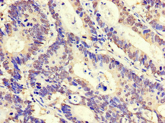 Immunohistochemistry of paraffin-embedded human colon cancer using CSB-PA027086LA01HU at dilution of 1:100