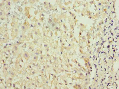 Immunohistochemistry of paraffin-embedded human liver cancer using CSB-PA05049A0Rb at dilution of 1:100