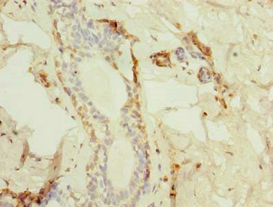 Immunohistochemistry of paraffin-embedded human breast cancer using CSB-PA05049A0Rb at dilution of 1:100