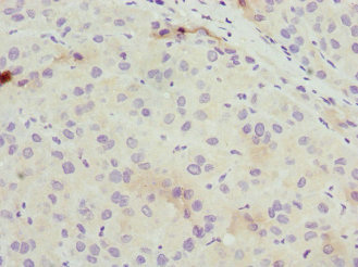 Immunohistochemistry of paraffin-embedded human liver cancer using CSB-PA11834A0Rb at dilution of 1:100