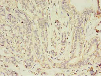 Immunohistochemistry of paraffin-embedded human breast cancer using CSB-PA12839A0Rb at dilution of 1:100