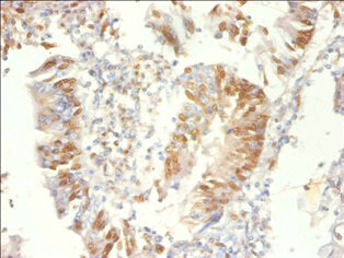 Immunohistochemistry of paraffin-embedded human colon cancer using CSB-PA13674A0Rb at dilution of 1:100 Immunohistochemistry of paraffin-embedded human colon cancer using CSB-PA13674A0Rb at dilution of 1:100