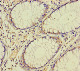 Immunohistochemistry of paraffin-embedded human colon cancer using CSB-PA624102LA01HU at dilution of 1:100