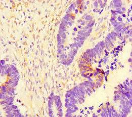 Immunohistochemistry of paraffin-embedded human ovarian cancer using CSB-PA754474LA01HU at dilution of 1:100