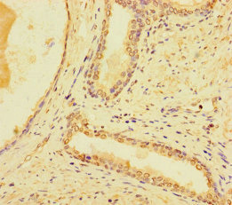 Immunohistochemistry of paraffin-embedded human prostate cancer using CSB-PA754474LA01HU at dilution of 1:100