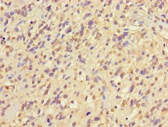 Immunohistochemistry of paraffin-embedded human glioma using CSB-PA810298LA01HU at dilution of 1:100