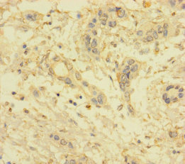 Immunohistochemistry of paraffin-embedded human pancreatic cancer using CSB-PA818673LA01HU at dilution of 1:100