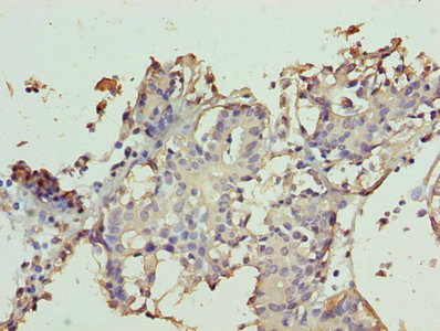 Immunohistochemistry of paraffin-embedded human breast cancer using CSB-PA836671LA01HU at dilution of 1:100