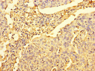 Immunohistochemistry of paraffin-embedded human cervical cancer using CSB-PA839297LA01HU at dilution of 1:100