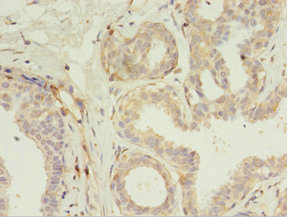 Immunohistochemistry of paraffin-embedded human breast cancer using CSB-PA850254LA01HU at dilution of 1:100