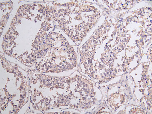 Immunohistochemistry of paraffin-embedded human colon cancer using CSB-PA850270LA01HU at dilution of 1:100
